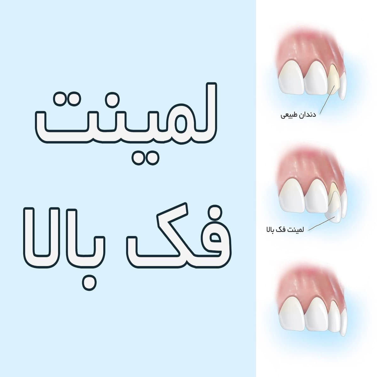 لمینت فک بالا چیست و قیمت آن چقدر است؟