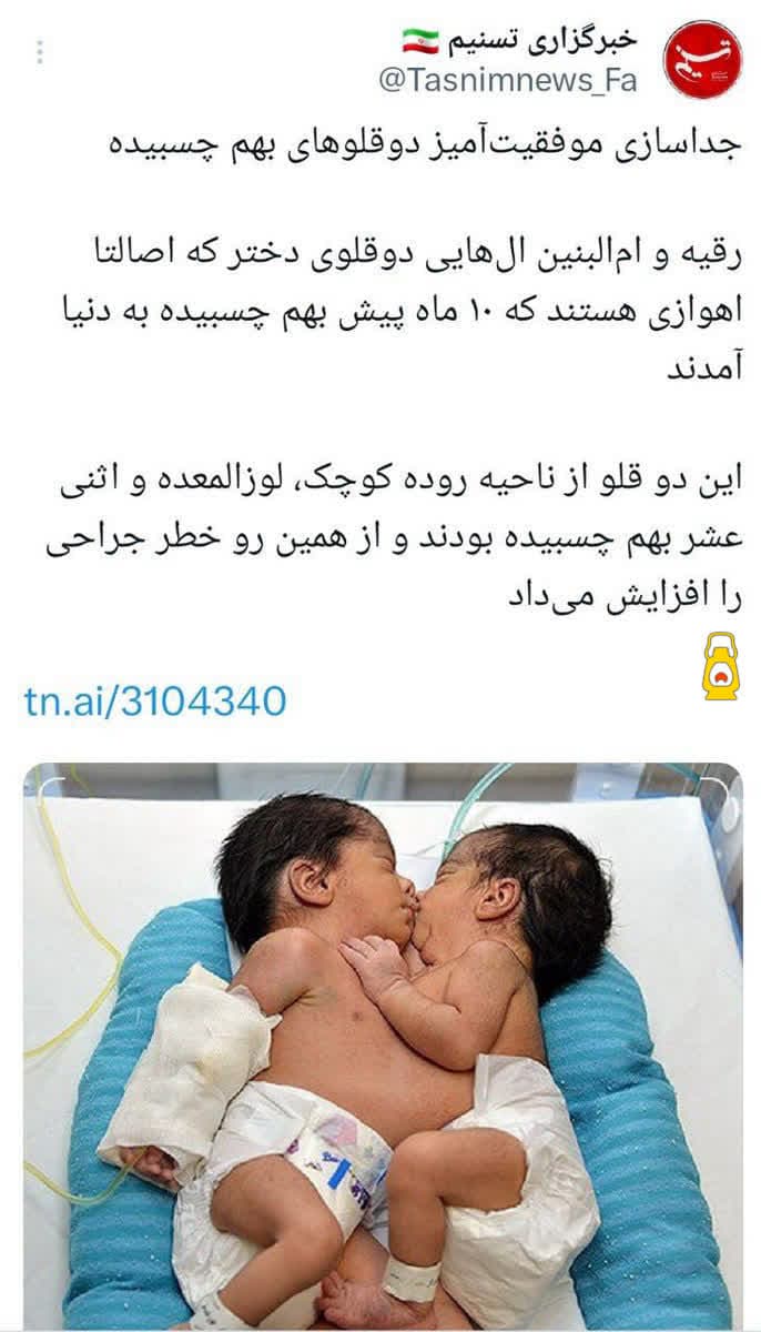  انجام عمل موفق آمیز جداسازی دوقلوهای بهم چسبیده‌ی با توان پزشکان، متخصصان و جراحان کشورمان??✌️