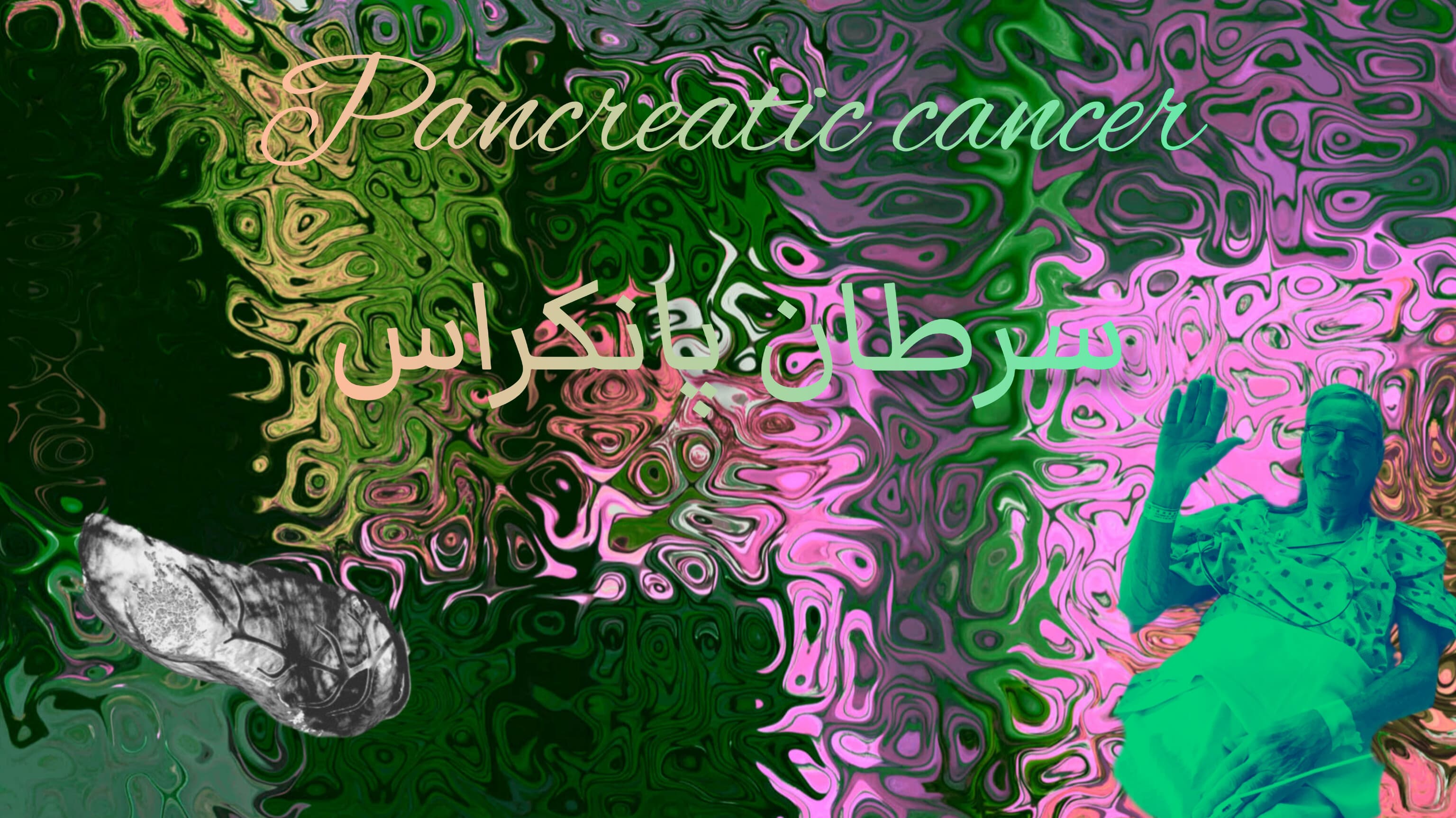 سرطان پانکراس/دردناک ترین سرطان دنیا