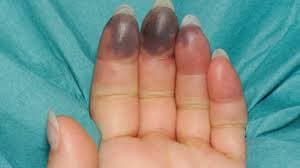 سپسیس چیست و چرا ایجاد می شود؟ سپسیس چه خطراتی دارد؟